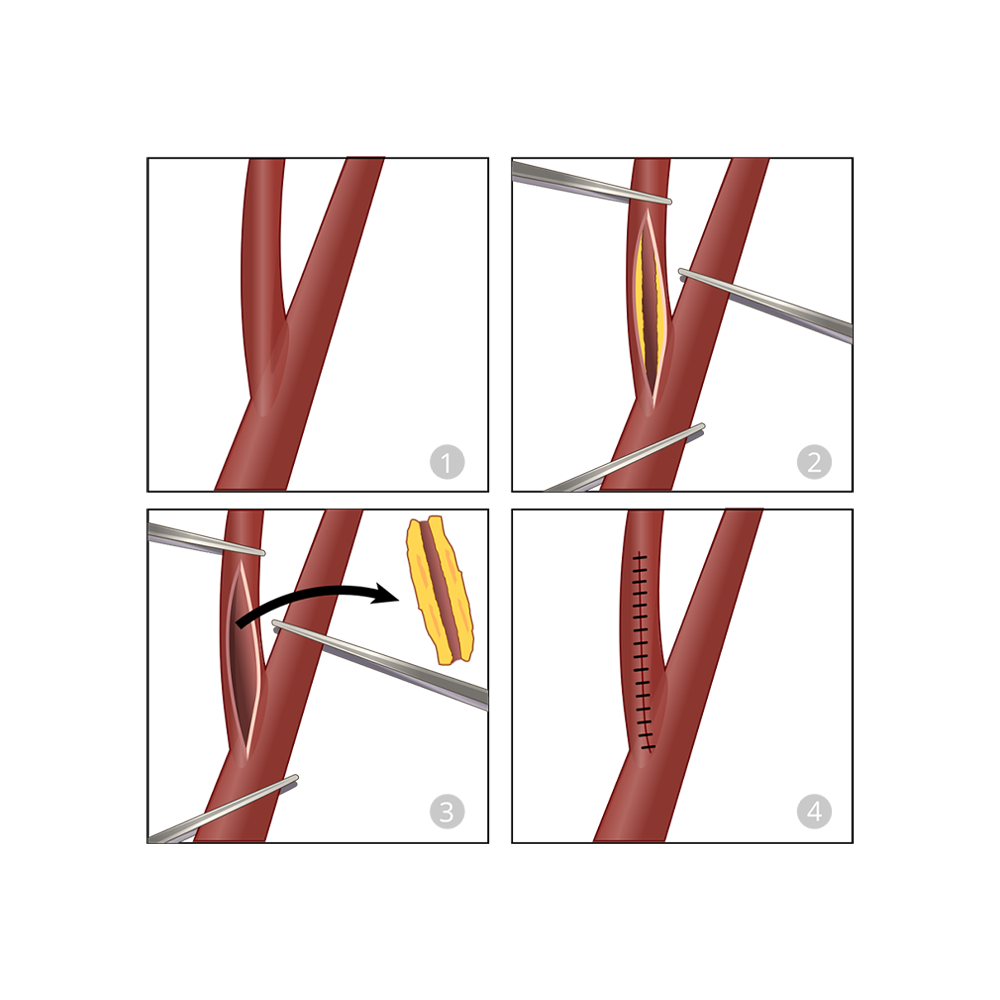 Coronary Endarterectomy